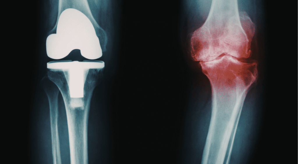 An X-ray comparison showing the knee joint before and after total knee replacement surgery as part of a post TKR physiotherapy in Indore recovery plan.