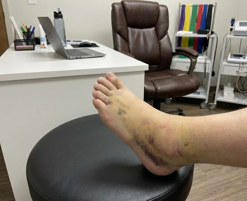 An acute ankle sprain in need of ankle sprain first aid in Indore at Dr Manisha Physiotherapy Clinic
