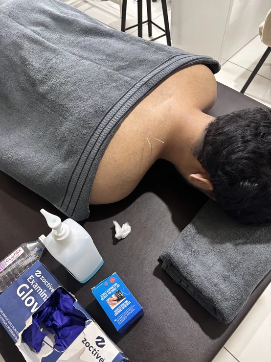 Dry Needling Therapy in Indore performed by Dr Manisha Mishra for neck pain.